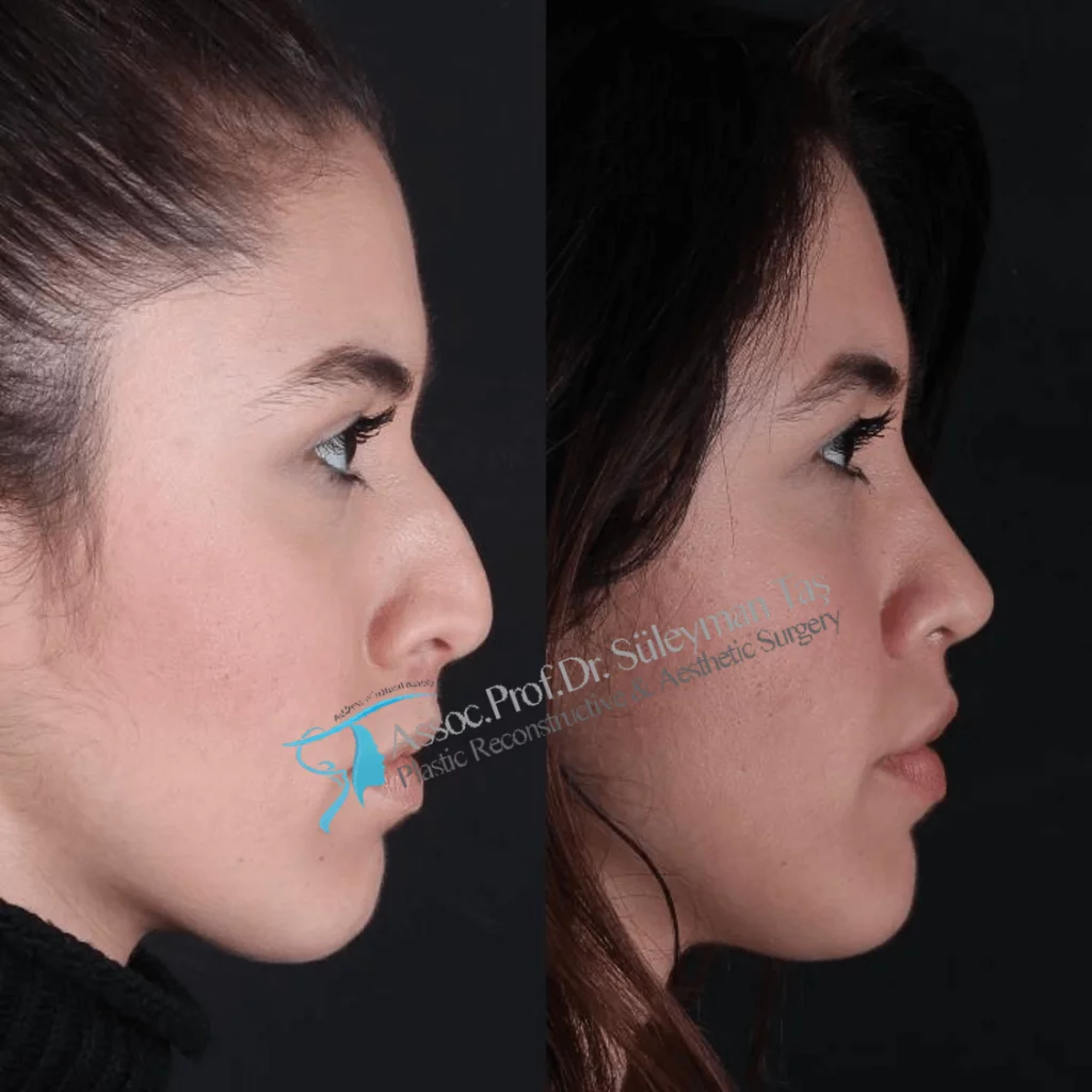 Suleyman Tas Before After Rhinoplasty