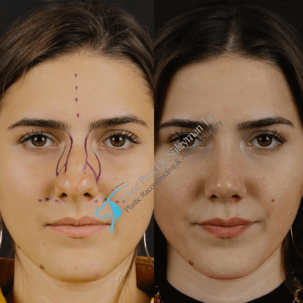 Suleyman Tas Before After Rhinoplasty