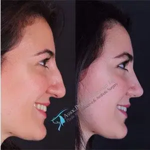 Suleyman Tas nostril reduction before after