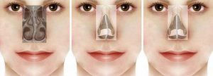 The nose takes an S shape