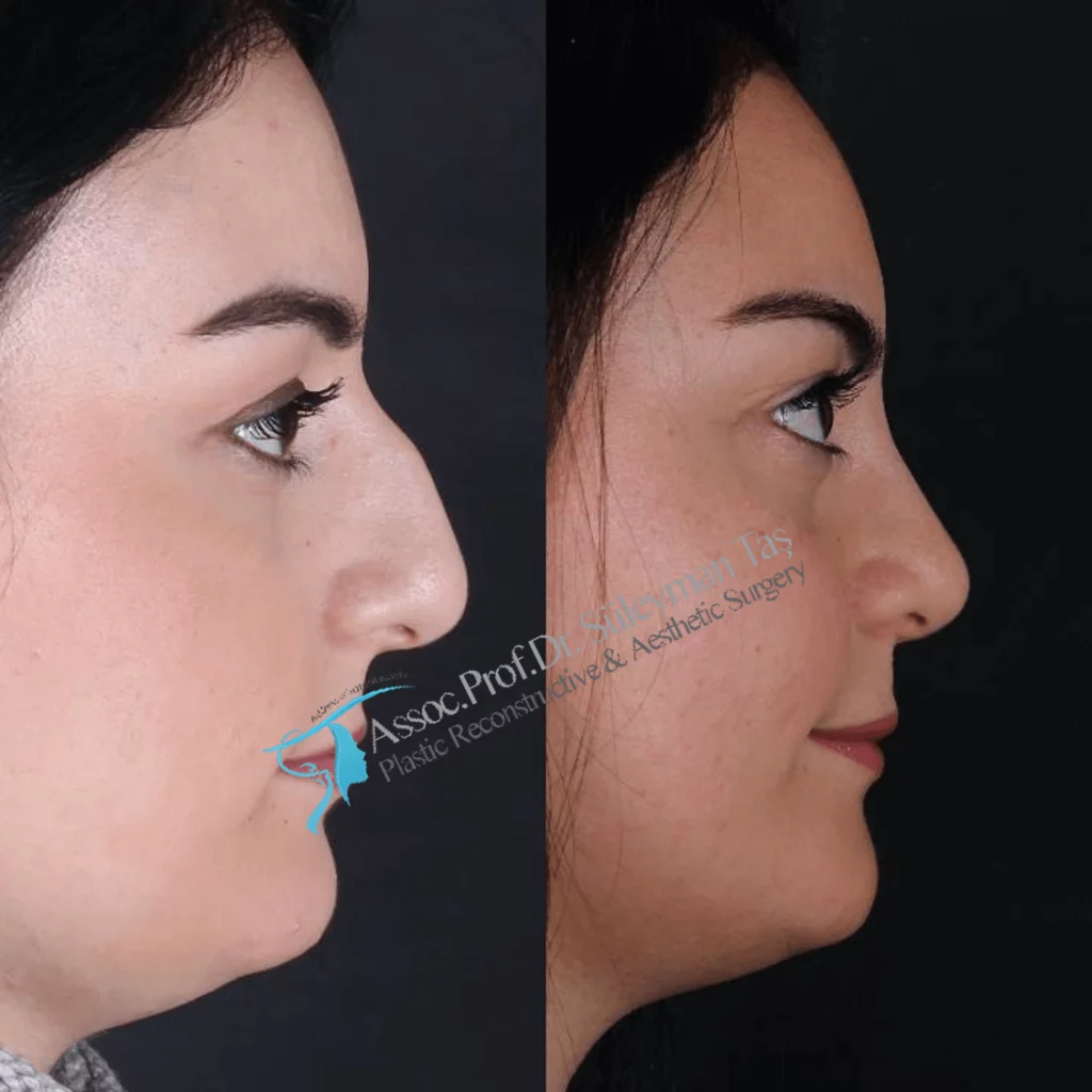 Suleyman Tas Before After Rhinoplasty