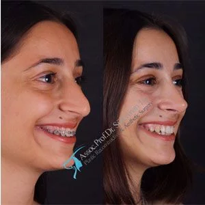 Suleyman Tas Before After Rhinoplasty