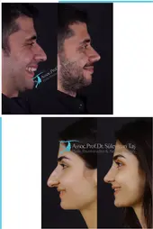 Male Rhinoplasty vs. Female Rhinoplasty