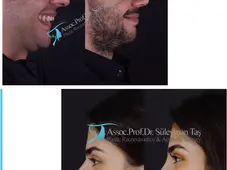 Male Rhinoplasty vs. Female Rhinoplasty