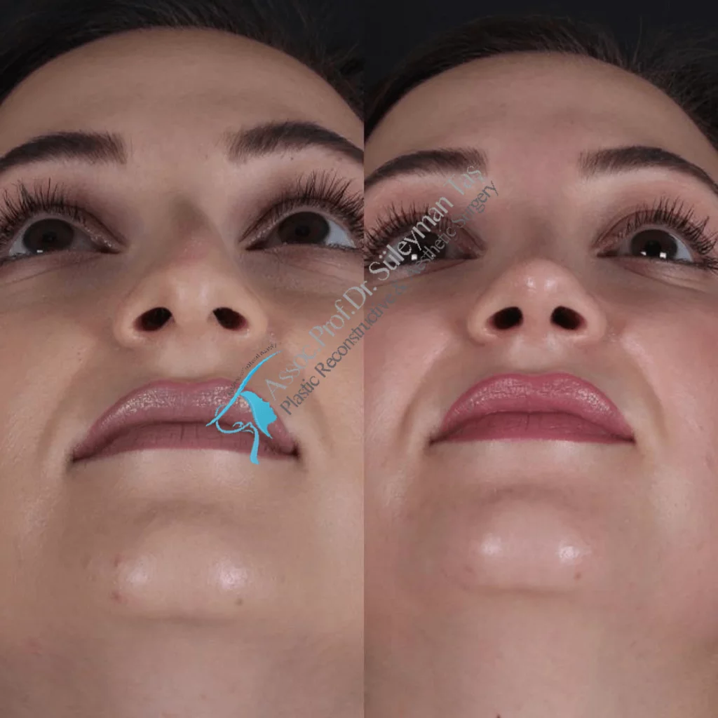 Suleyman Tas Before After Rhinoplasty