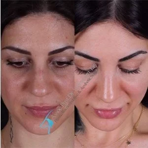 Revision Rhinoplasty Transformation Dr Suleyman Tas