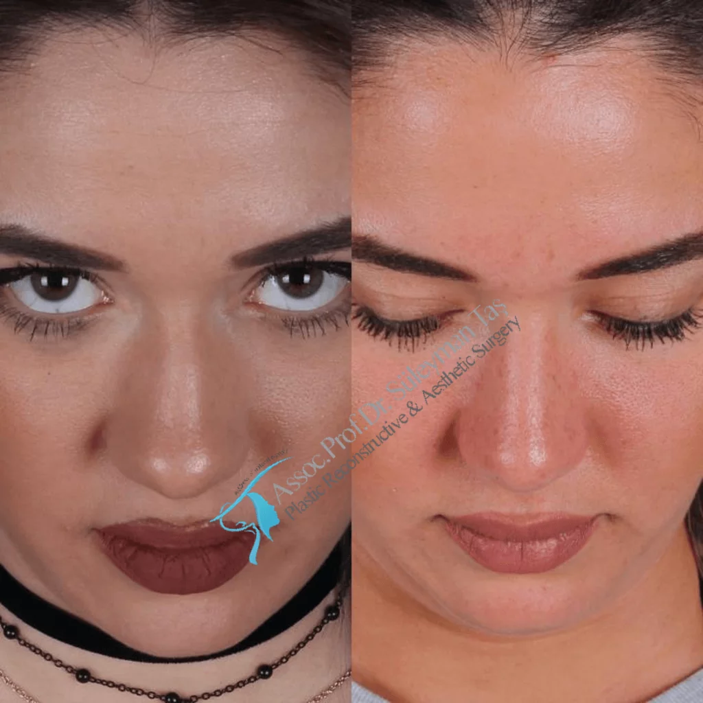 Suleyman Tas Before After Rhinoplasty