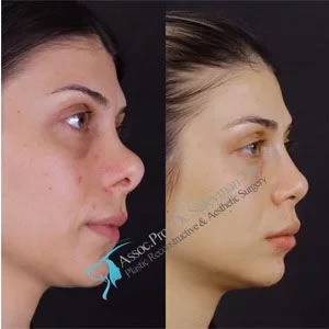 Dr Suleyman Tas Revision Rhinoplasty Results