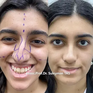 Case Study Number 16 – Nose enhancement