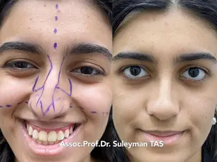 Case Study Number 16 – Nose enhancement