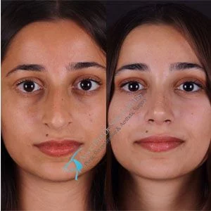 Suleyman Tas Before After Rhinoplasty