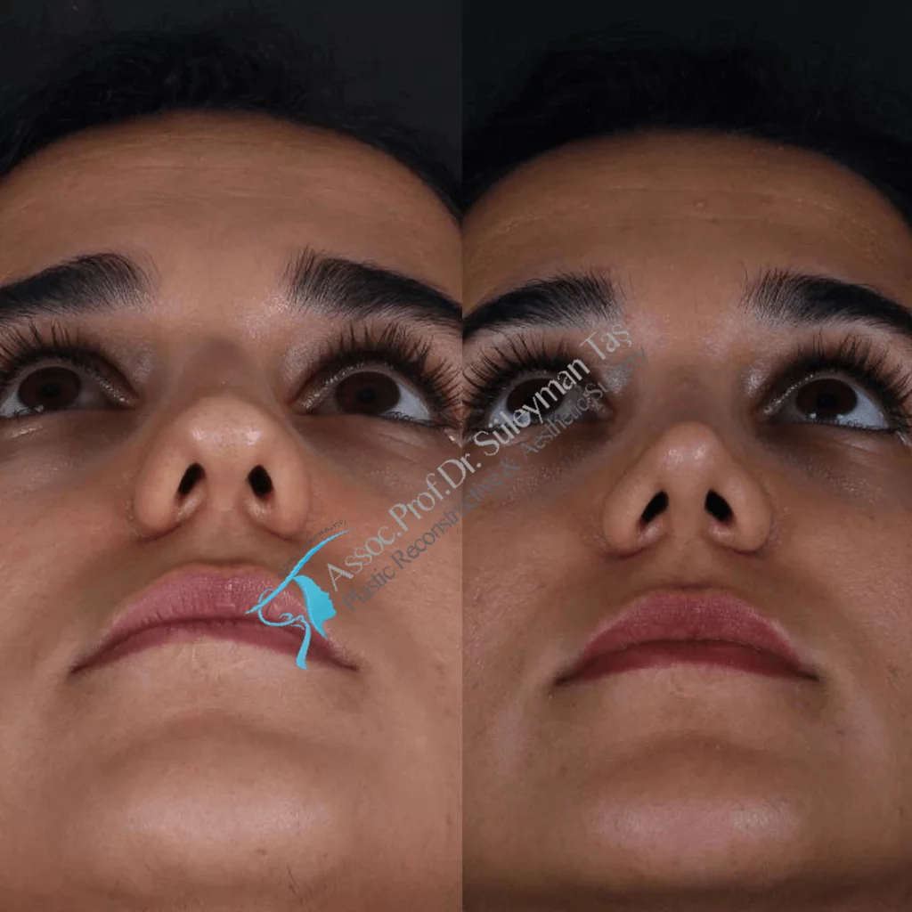 Suleyman Tas Before After Rhinoplasty