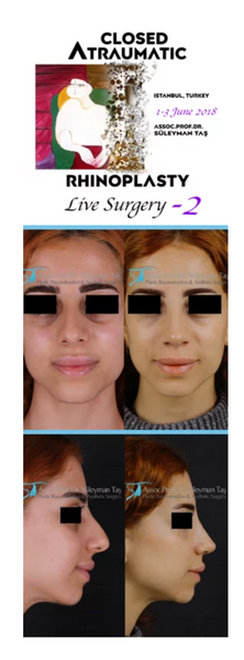 Closed Atraumatic Rhinoplasty Live Surgery