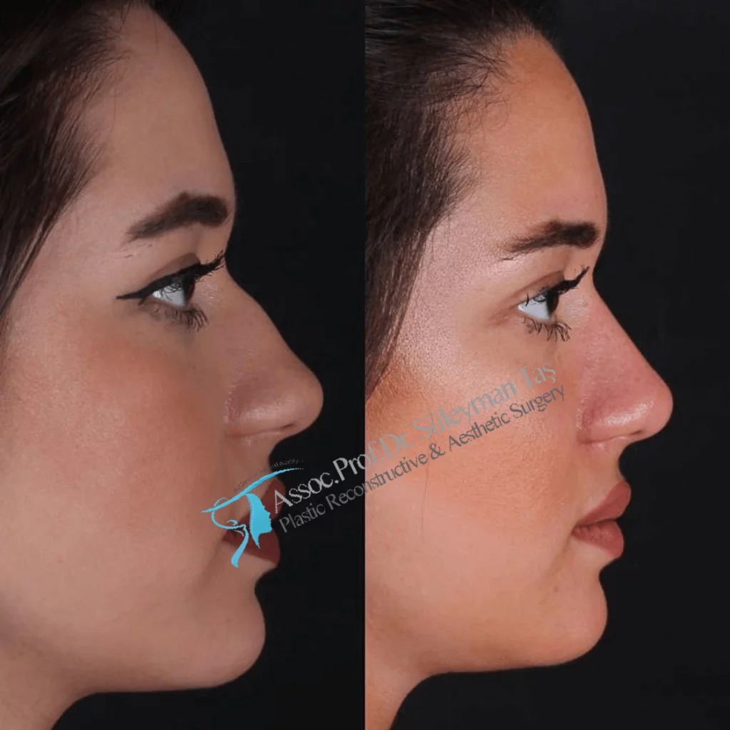 Suleyman Tas Before After Rhinoplasty
