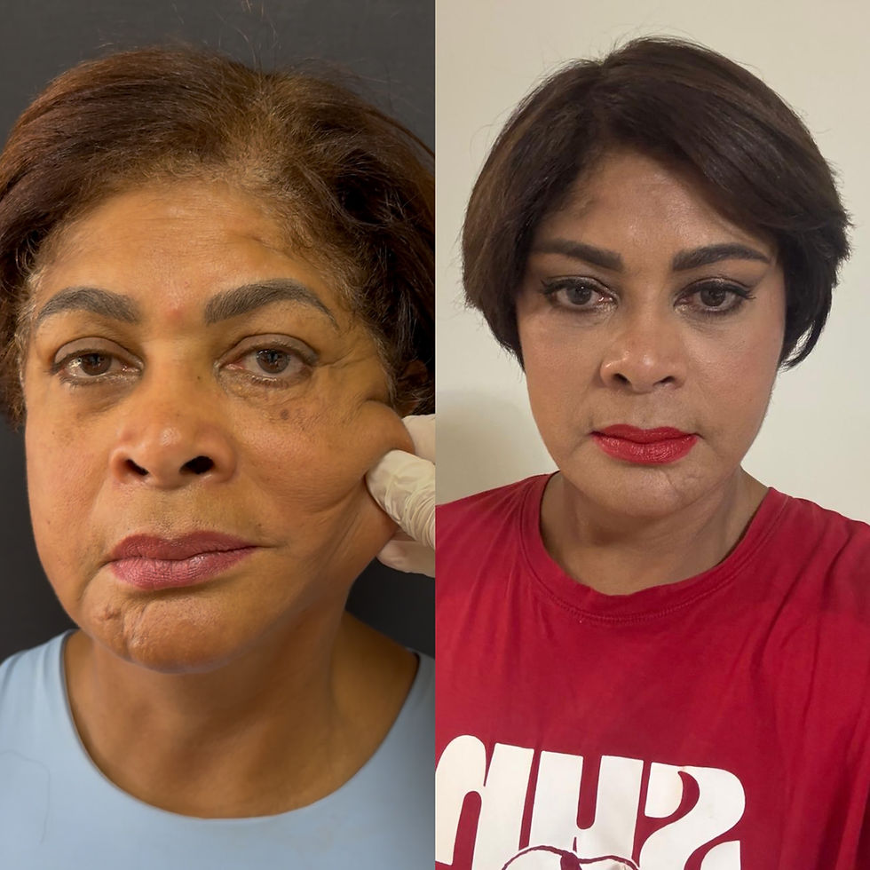 Facelift Before and After: How Results Change Over 12 Months