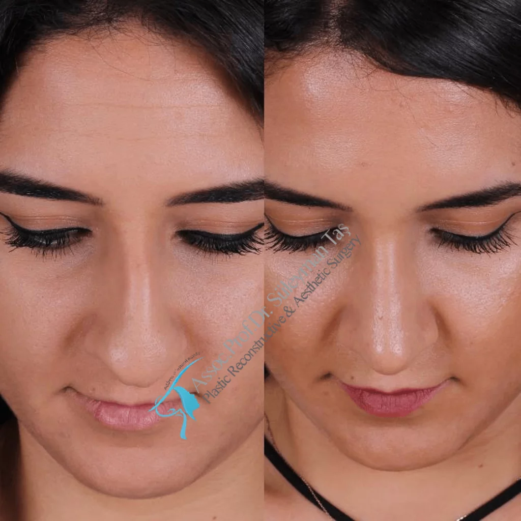 Suleyman Tas Before After Rhinoplasty