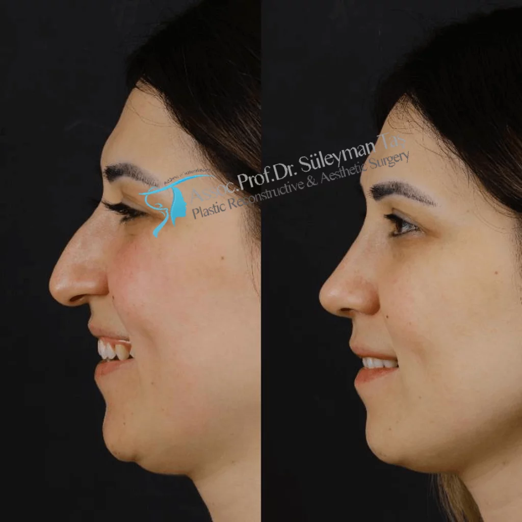 Suleyman Tas Before After Rhinoplasty