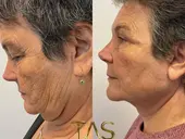 Case Study Number 19 – Expert facelift for aged skin