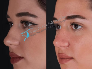 Suleyman Tas Natural Rhinoplasty Before After Results