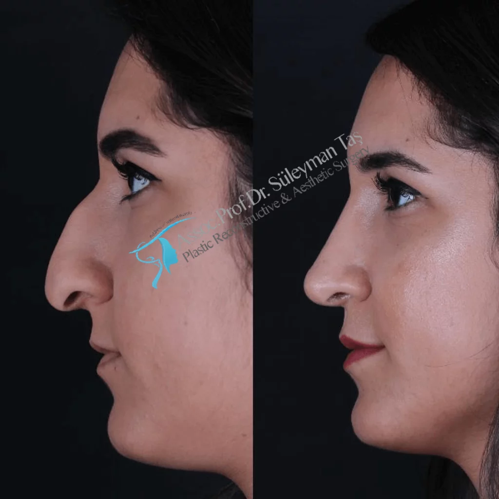 Suleyman Tas Before After Rhinoplasty