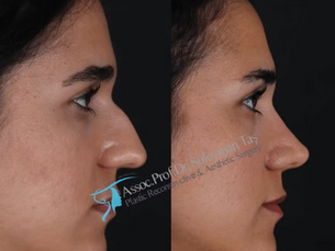 Suleyman Tas Closed Rhinoplasty Before After Results