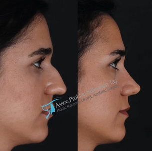 Suleyman Tas Closed Rhinoplasty Before After Results