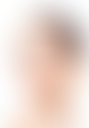 How a Rhinoplasty Can Help a Deviated Septum?