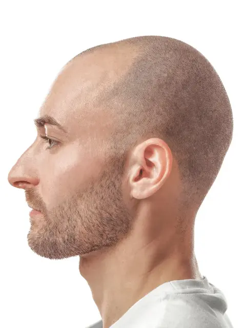 Prof.Dr. Suleyman TAS Hair Transplant
