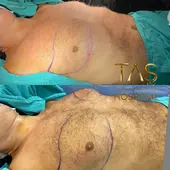 Case Study Number 23 – Gynecomastia