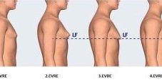 Male Breast Aesthetics (Gynecomastia)