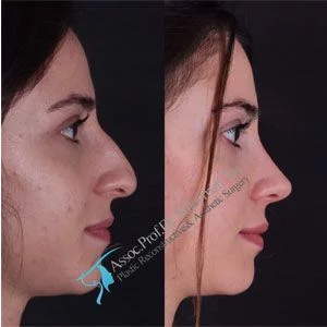 Suleyman Tas Before After Rhinoplasty