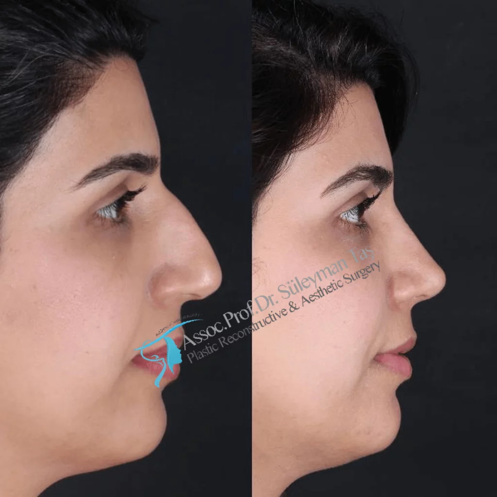 Suleyman Tas Before After Rhinoplasty