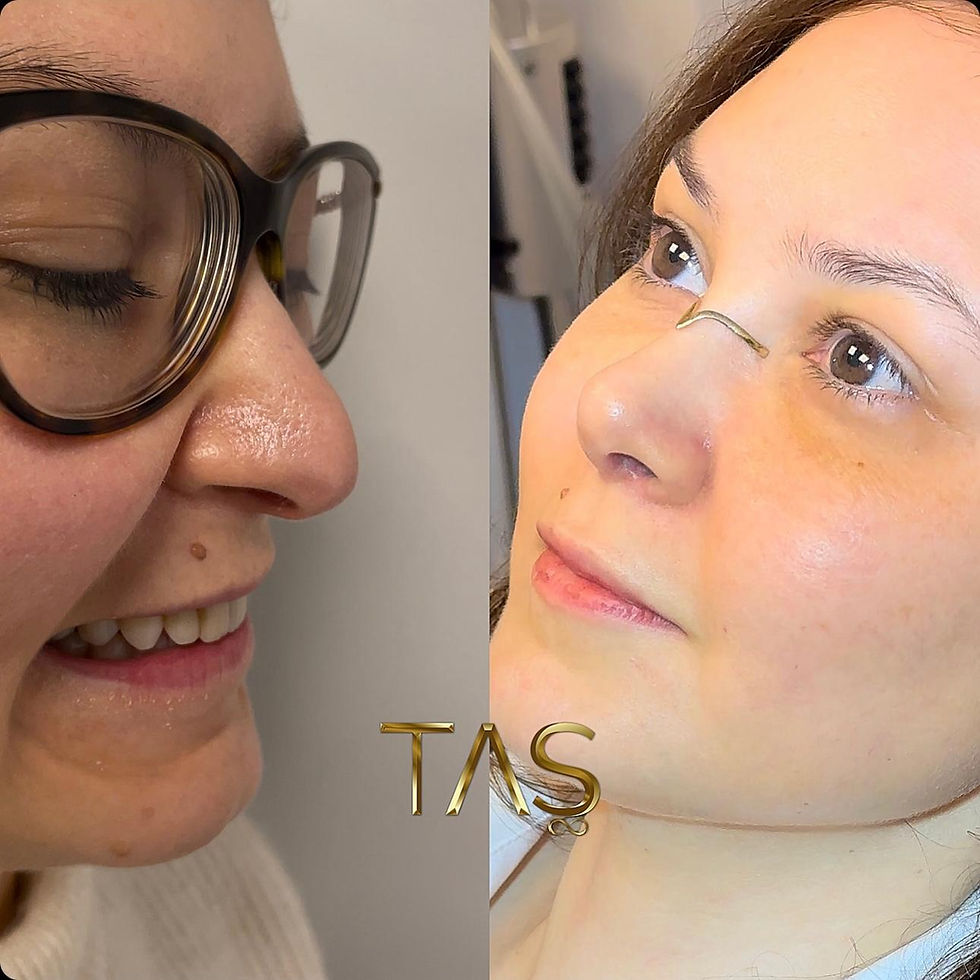 Facelift in Turkey for International Patients: Safety, Trip and Aftercare
