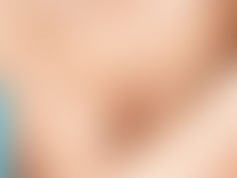 Scarring After Breast Surgery
