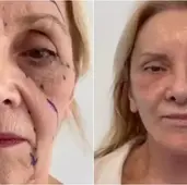Estetikle Bir Anda 30 Yaş Birden Gençleşen 74 Yaşındaki Kadının İnanılmaz Değişimi