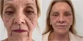 Estetikle Bir Anda 30 Yaş Birden Gençleşen 74 Yaşındaki Kadının İnanılmaz Değişimi