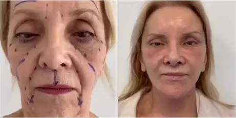 Estetikle Bir Anda 30 Yaş Birden Gençleşen 74 Yaşındaki Kadının İnanılmaz Değişimi