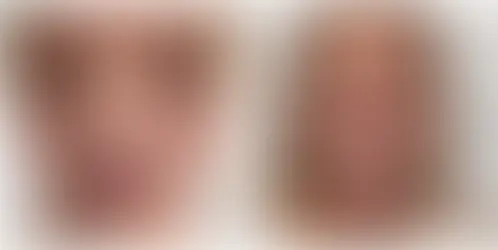 Estetikle Bir Anda 30 Yaş Birden Gençleşen 74 Yaşındaki Kadının İnanılmaz Değişimi