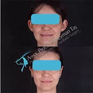 facelift-necklift-foxeyes-ear-surgery-before-and-after-gallery-4.webp