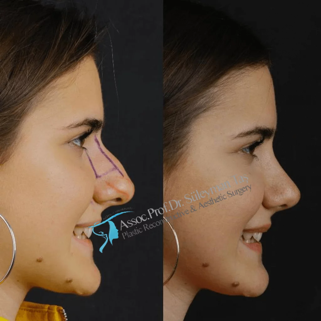 Suleyman Tas Before After Rhinoplasty