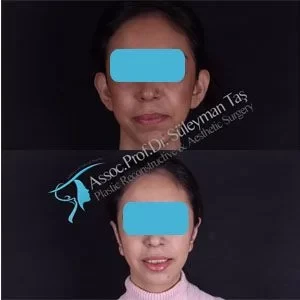 facelift-necklift-foxeyes-ear-surgery-before-and-after-gallery-20 (1).webp