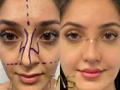 Case Study Number 15 – Nose Surgery