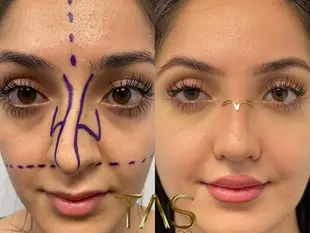 Case Study Number 15 – Nose Surgery