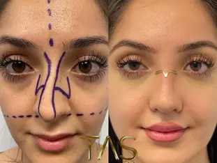 Case Study Number 15 – Nose Surgery