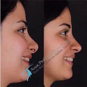 Dr Suleyman Tas Revision Nose Job Results