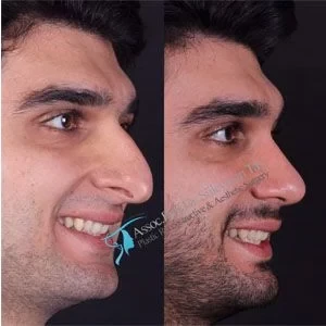 Dr Suleyman Tas Male Nose Job Results