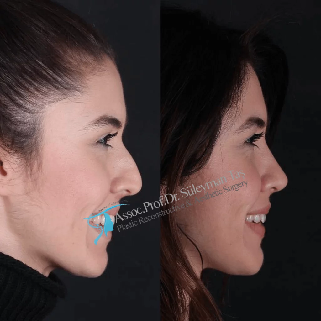 Suleyman Tas Before After Rhinoplasty