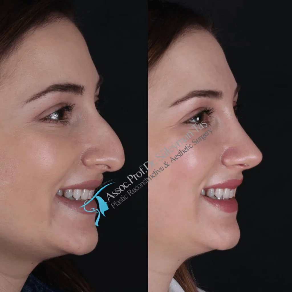 Suleyman Tas Before After Rhinoplasty