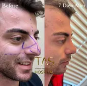 Case Study Number 17 – Male Nose Reshaping