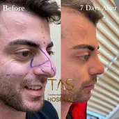 Case Study Number 17 – Male Nose Reshaping
